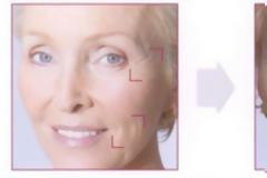 Ρυτίδες Έκφρασης: Σύγχρονη μέθοδος καταπολέμησης με μη ενέσιμο τρόπο;