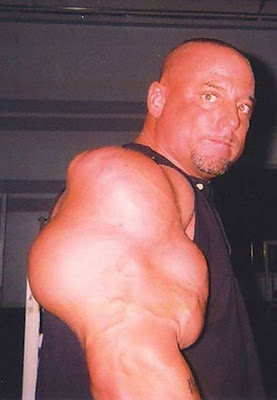 Ακόμα ένα θύμα του bodybuilding που χρησιμοποίησε την ουσία synthol - Φωτογραφία 8