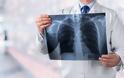 Στους 37 οι θάνατοι από τη μυστηριώδη πνευμονική ασθένεια που συνδέεται με το άτμισμα