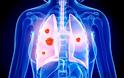 Ένας στους εννιά καπνιστές θα εμφανίσει καρκίνο του πνεύμονα. 7000 το χρόνο