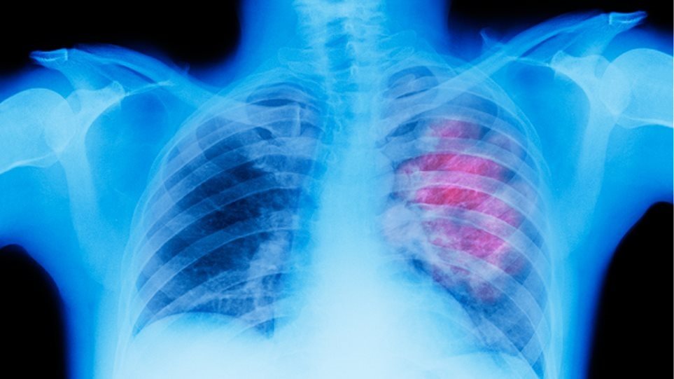 Καρκίνος του πνεύμονα: H πιο συχνή μορφή καρκίνου στους άνδρες, η τρίτη στις γυναίκες - Φωτογραφία 1