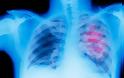 Καρκίνος του πνεύμονα: H πιο συχνή μορφή καρκίνου στους άνδρες, η τρίτη στις γυναίκες