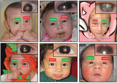 Παιδιά: Εφαρμογή για smartphone εντοπίζει οφθαλμοπάθειες στις φωτογραφίες - Φωτογραφία 1