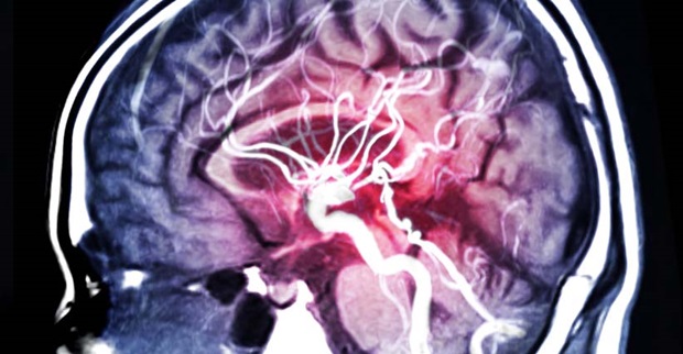 Όγκος στον εγκέφαλο : Νέο τεστ με τεχνητή νοημοσύνη δίνει έγκαιρα διάγνωση - Φωτογραφία 1