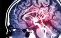 Όγκος στον εγκέφαλο : Νέο τεστ με τεχνητή νοημοσύνη δίνει έγκαιρα διάγνωση