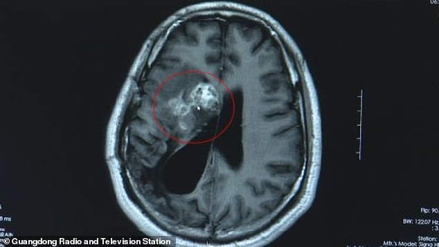 Σκουλήκι ζούσε και έτρωγε τον εγκέφαλο του επί 15 χρόνια - Φωτογραφία 2