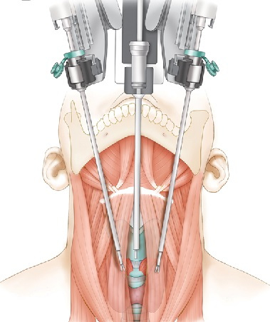 Επαναστατική τεχνική στην χειρουργική του θυρεοειδούς χωρίς τομές στον λαιμό και δύσμορφες ουλές - Φωτογραφία 1