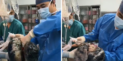 Χειρουργός στην Κίνα δείχνει πως μοιάζουν οι πνεύμονες ενός καπνιστή επί 30 χρόνια (video) - Φωτογραφία 1