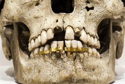 Εντυπωσιακά ευρήματα με αρχαία οδοντικά εμφυτεύματα που προέρχονταν από άλλους ανθρώπους και βόδια. Οι Ετρούσκοι ήταν οι πρώτοι που ασχολήθηκαν με την προσθετική οδοντιατρική και σταθεροποιούσαν τα δόντια με χρυσά ελάσματα - Φωτογραφία 1