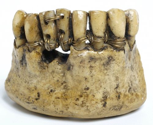 Εντυπωσιακά ευρήματα με αρχαία οδοντικά εμφυτεύματα που προέρχονταν από άλλους ανθρώπους και βόδια. Οι Ετρούσκοι ήταν οι πρώτοι που ασχολήθηκαν με την προσθετική οδοντιατρική και σταθεροποιούσαν τα δόντια με χρυσά ελάσματα - Φωτογραφία 2