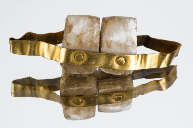 Εντυπωσιακά ευρήματα με αρχαία οδοντικά εμφυτεύματα που προέρχονταν από άλλους ανθρώπους και βόδια. Οι Ετρούσκοι ήταν οι πρώτοι που ασχολήθηκαν με την προσθετική οδοντιατρική και σταθεροποιούσαν τα δόντια με χρυσά ελάσματα - Φωτογραφία 3