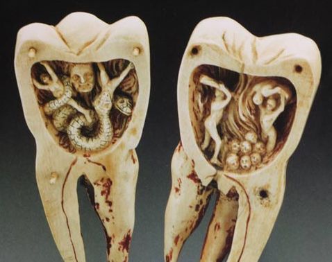 Εντυπωσιακά ευρήματα με αρχαία οδοντικά εμφυτεύματα που προέρχονταν από άλλους ανθρώπους και βόδια. Οι Ετρούσκοι ήταν οι πρώτοι που ασχολήθηκαν με την προσθετική οδοντιατρική και σταθεροποιούσαν τα δόντια με χρυσά ελάσματα - Φωτογραφία 4
