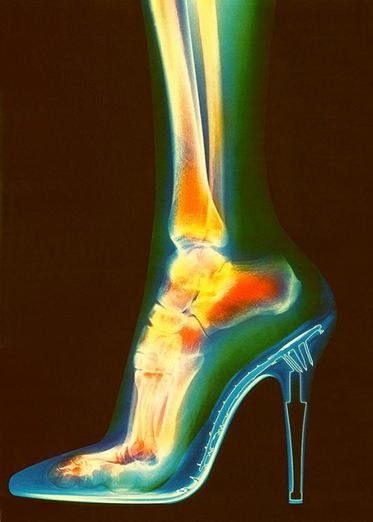Τα ψηλοτάκουνα, τι προβλήματα μπορεί να δημιουργήσουν στα πόδια σας; Τι πρέπει να προσέχετε; - Φωτογραφία 3