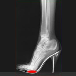 Τα ψηλοτάκουνα, τι προβλήματα μπορεί να δημιουργήσουν στα πόδια σας; Τι πρέπει να προσέχετε; - Φωτογραφία 4