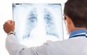 Καρκίνος πνεύμονα: Πρώτη αιτία θανάτου στην Ελλάδα
