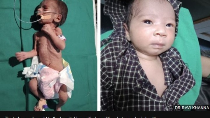 Ινδία: Το νεογέννητο κοριτσάκι που είχε βρεθεί θαμμένο ζωντανό μέσα σε αυτοσχέδιο τάφο έχει αναρρώσει πλήρως - Φωτογραφία 1