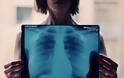 Σύστημα της Google γνωματεύει ακτινογραφίες των πνευμόνων εξίσου καλά με ακτινολόγους