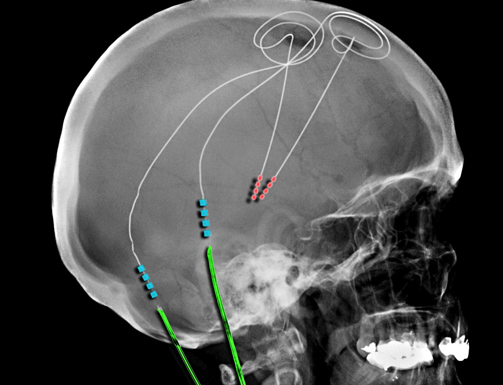 DBS: Η τεχνική εμφύτευσης ηλεκτροδίων που ρυθμίζει τα κυκλώματα του εγκεφάλου - Φωτογραφία 3