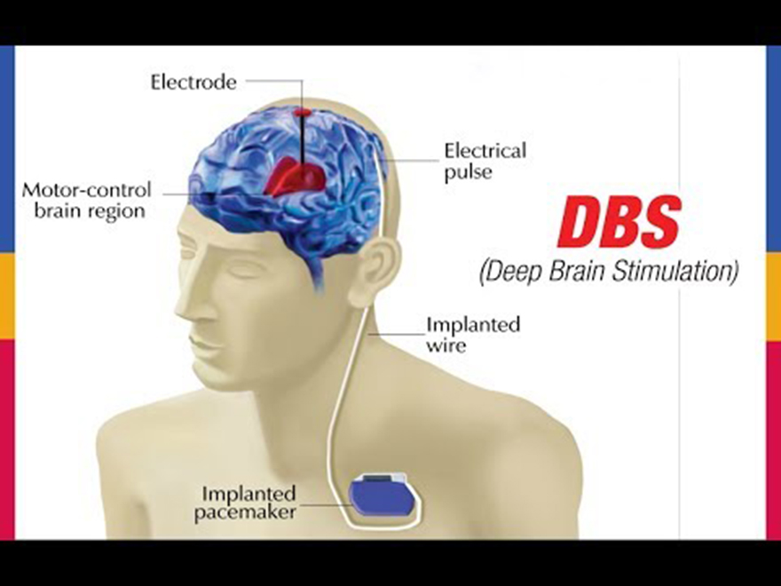 DBS: Η τεχνική εμφύτευσης ηλεκτροδίων που ρυθμίζει τα κυκλώματα του εγκεφάλου - Φωτογραφία 5