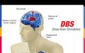 DBS: Η τεχνική εμφύτευσης ηλεκτροδίων που ρυθμίζει τα κυκλώματα του εγκεφάλου - Φωτογραφία 5