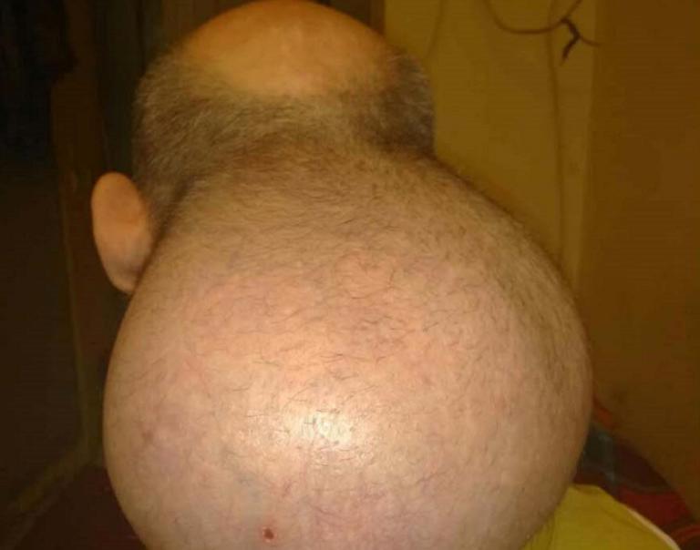 Εικόνες σοκ από τις Σέρρες: Κρατούμενος με όγκο στο κεφάλι που μεγαλώνει συνεχώς! Το ξέσπασμα και η κραυγή αγωνίας του (ΕΙΚΟΝΕΣ) - Φωτογραφία 1