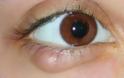 Κριθαράκι στο μάτι: 5 τρόποι σπιτικής αντιμετώπισης και πρόληψης