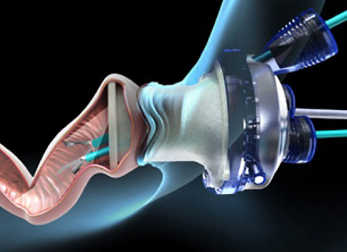 Διορθική Ενδοσκοπική Χειρουργική: Η σύγχρονη μέθοδος αφαίρεσης όγκων του ορθού - Φωτογραφία 2