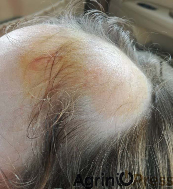 Σοκαριστικό ατύχημα σε Νηπιαγωγείο του Αγρινίου: Ξεριζώθηκαν από κούνια τα μαλλιά πεντάχρονης! - Φωτογραφία 1