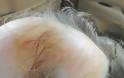 Σοκαριστικό ατύχημα σε Νηπιαγωγείο του Αγρινίου: Ξεριζώθηκαν από κούνια τα μαλλιά πεντάχρονης!