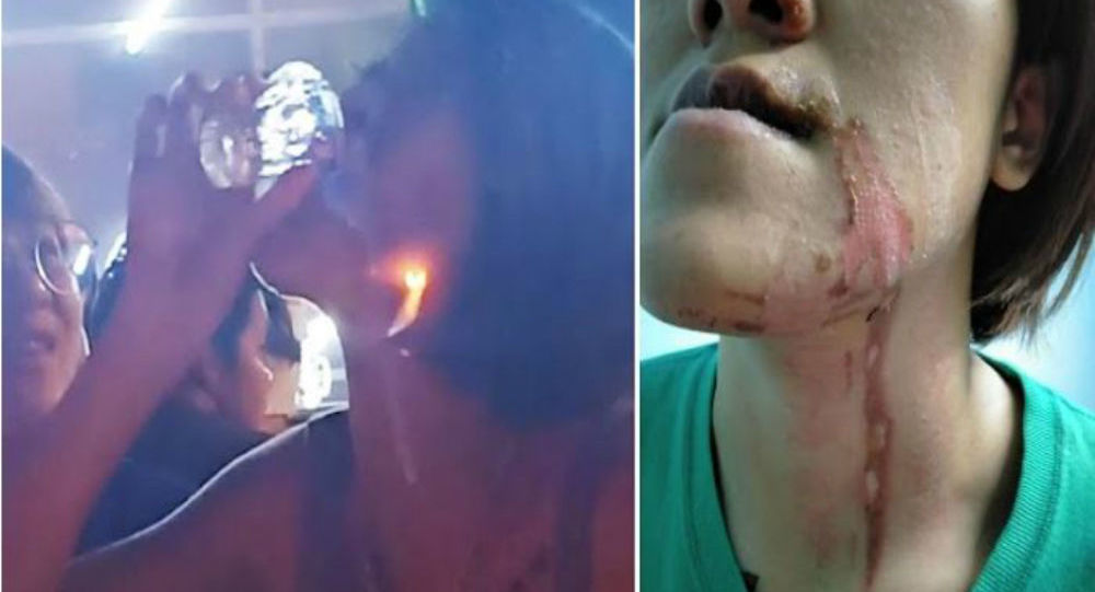 Βίντεο: Νεαρή ήπιε σφηνάκι τεκίλα με... φωτιά και κάηκε το πρόσωπό της - Φωτογραφία 1