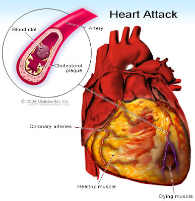 ΠΡΟΣΟΧΉ συμπτώματα που προειδοποιούν για έμφραγμα, καρδιακή προσβολή και πρέπει να πάτε άμεσα σε καρδιολόγο - Φωτογραφία 2