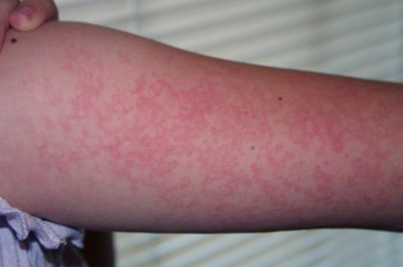 Τι είναι η αλλεργία; Πώς εκδηλώνεται μια αλλεργική αντίδραση; Πώς αντιμετωπίζεται; - Φωτογραφία 4
