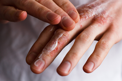 Πώς να περιποιηθείτε τα χέρια σας για την δερματίτιδα από το πλύσιμο και τα γάντια - Φωτογραφία 1