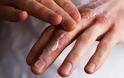 Πώς να περιποιηθείτε τα χέρια σας για την δερματίτιδα από το πλύσιμο και τα γάντια
