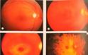 Μέχρι τύφλωση μπορεί να προκαλέσει η χρήση χλωροκίνης και υδροξυχλωροκίνης