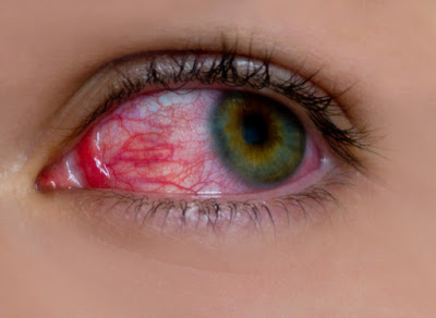 Αίμα στο μάτι από σπασμένα αιμοφόρα αγγεία,  Υπόσφαγμα - Φωτογραφία 1