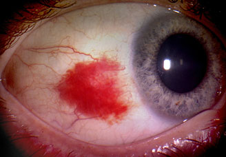 Αίμα στο μάτι από σπασμένα αιμοφόρα αγγεία,  Υπόσφαγμα - Φωτογραφία 2