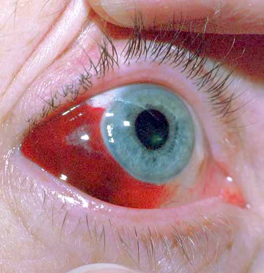 Αίμα στο μάτι από σπασμένα αιμοφόρα αγγεία,  Υπόσφαγμα - Φωτογραφία 3