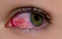 Αίμα στο μάτι από σπασμένα αιμοφόρα αγγεία,  Υπόσφαγμα - Φωτογραφία 1