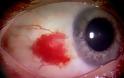 Αίμα στο μάτι από σπασμένα αιμοφόρα αγγεία,  Υπόσφαγμα - Φωτογραφία 2