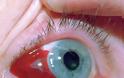 Αίμα στο μάτι από σπασμένα αιμοφόρα αγγεία,  Υπόσφαγμα - Φωτογραφία 3
