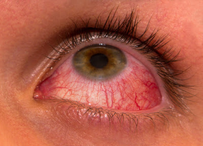 Επιπεφυκίτιδα με τσίμπλα, δάκρυα, πρήξιμο, κόκκινα ερεθισμένα μάτια - Φωτογραφία 1