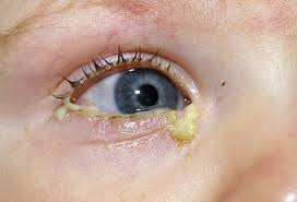 Επιπεφυκίτιδα με τσίμπλα, δάκρυα, πρήξιμο, κόκκινα ερεθισμένα μάτια - Φωτογραφία 3