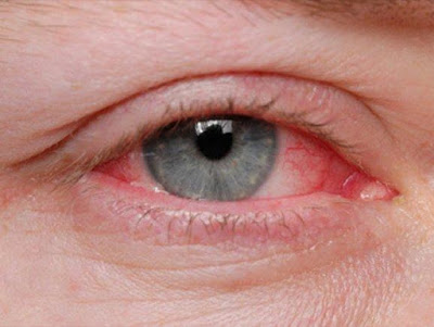Επιπεφυκίτιδα με τσίμπλα, δάκρυα, πρήξιμο, κόκκινα ερεθισμένα μάτια - Φωτογραφία 5