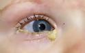 Επιπεφυκίτιδα με τσίμπλα, δάκρυα, πρήξιμο, κόκκινα ερεθισμένα μάτια - Φωτογραφία 3