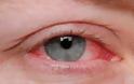 Επιπεφυκίτιδα με τσίμπλα, δάκρυα, πρήξιμο, κόκκινα ερεθισμένα μάτια - Φωτογραφία 5