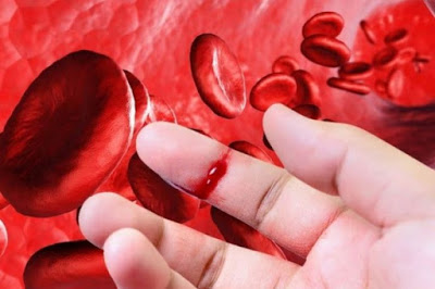 Αιμορροφιλία. Τι είναι, τι προκαλεί και πώς αντιμετωπίζεται; Πρώτες βοήθειες αιμορραγικού επεισοδίου - Φωτογραφία 1