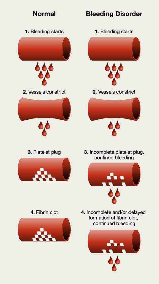 Αιμορροφιλία. Τι είναι, τι προκαλεί και πώς αντιμετωπίζεται; Πρώτες βοήθειες αιμορραγικού επεισοδίου - Φωτογραφία 4
