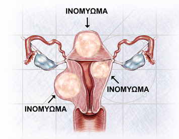 Ινομυώματα. Ποια τα συμπτώματά; Τι μπορεί να προκαλέσουν στην κύηση και τον τοκετό; - Φωτογραφία 2