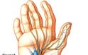 Τενοντίτιδα με πόνο χαμηλά στο χέρι στον καρπό. Αιτίες που συμβαίνει και πώς προλαμβάνεται; - Φωτογραφία 3
